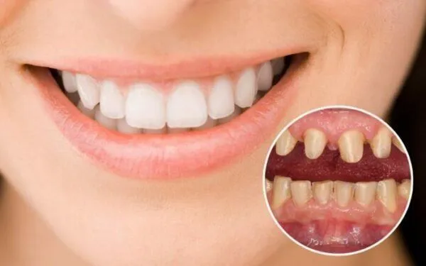 răng lộn xộn có bọc sứ được không