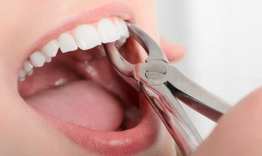 tác hại của việc nhổ răng số 4