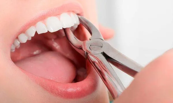 có nên giữ lại răng khôn sau khi nhổ