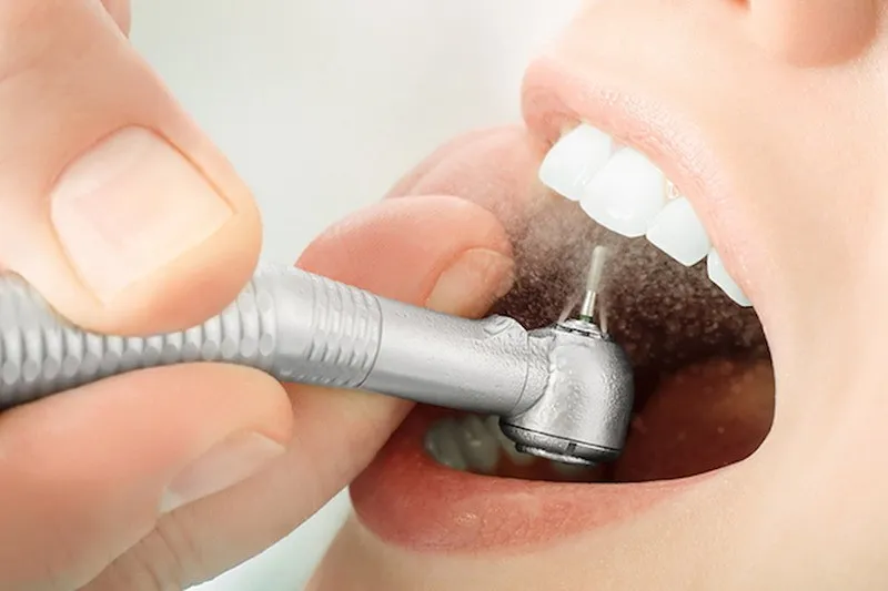 Nên lấy cao răng bao lâu 1 lần