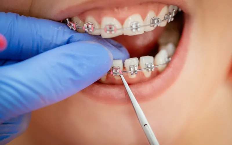 Các yếu tố ảnh hưởng thời gian niềng răng 2 hàm