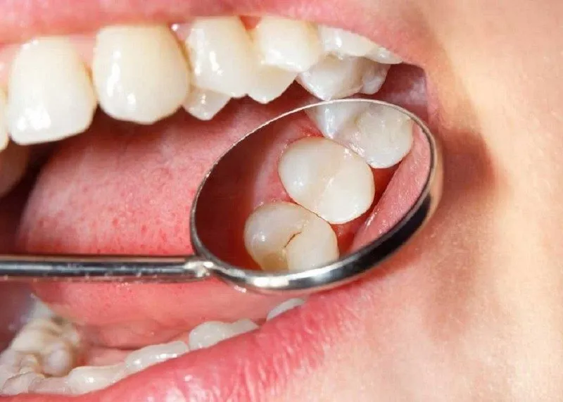 Sâu răng nhẹ là gì?