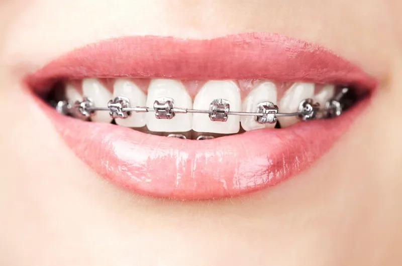 Tổng quan về niềng răng