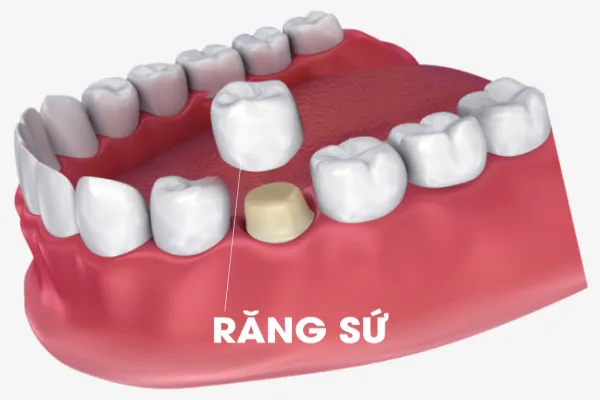 rang-su-1