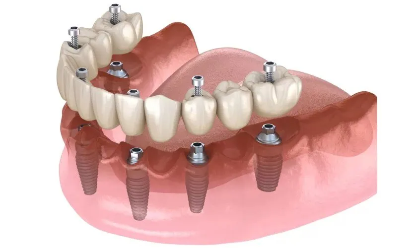 -implant-toan-ham