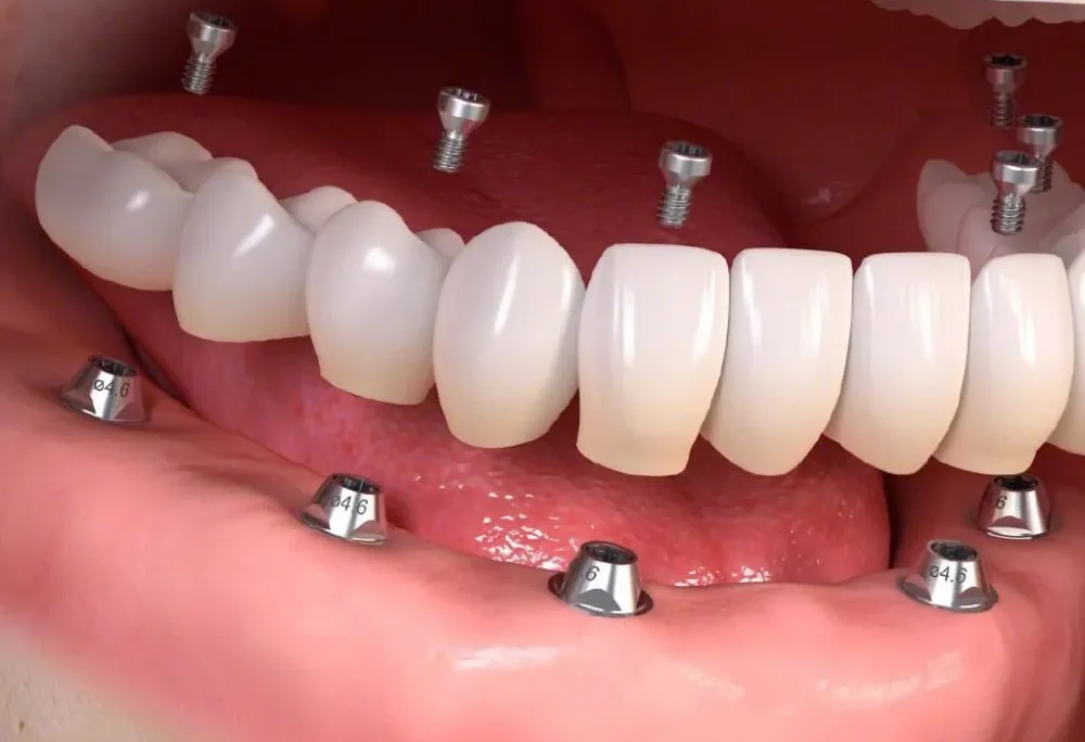 dich-vu-trong-rang-implant-hai-phong-2