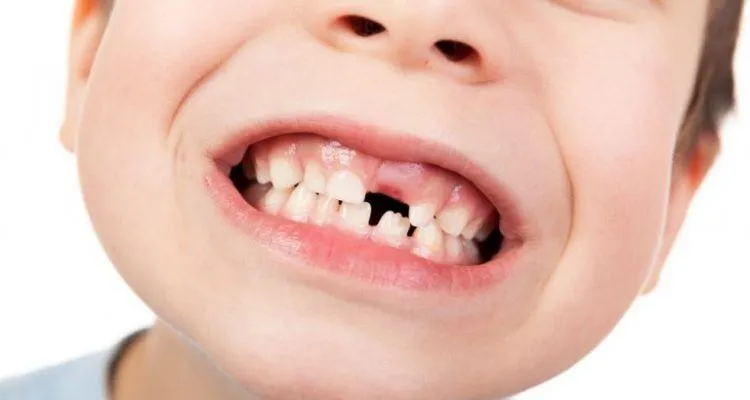 Nguyên Quy Trình Thay Răng Diễn Rakhiến răng sữa không thay