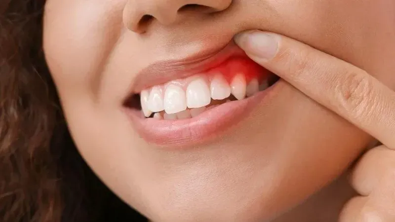 nướu sưng