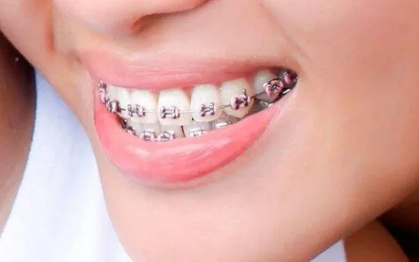 khớp cắn đối đầu