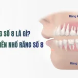 răng số 8 có nên nhổ không