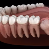 cách chữa đau răng số 8