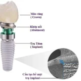 cấu tạo implant