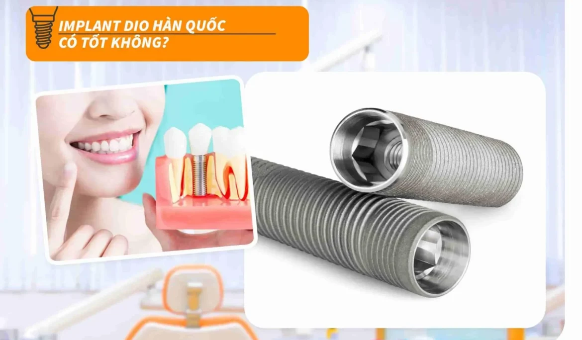 implant dio hàn quốc có tốt không