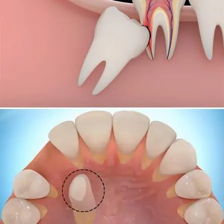 kéo răng mọc ngầm