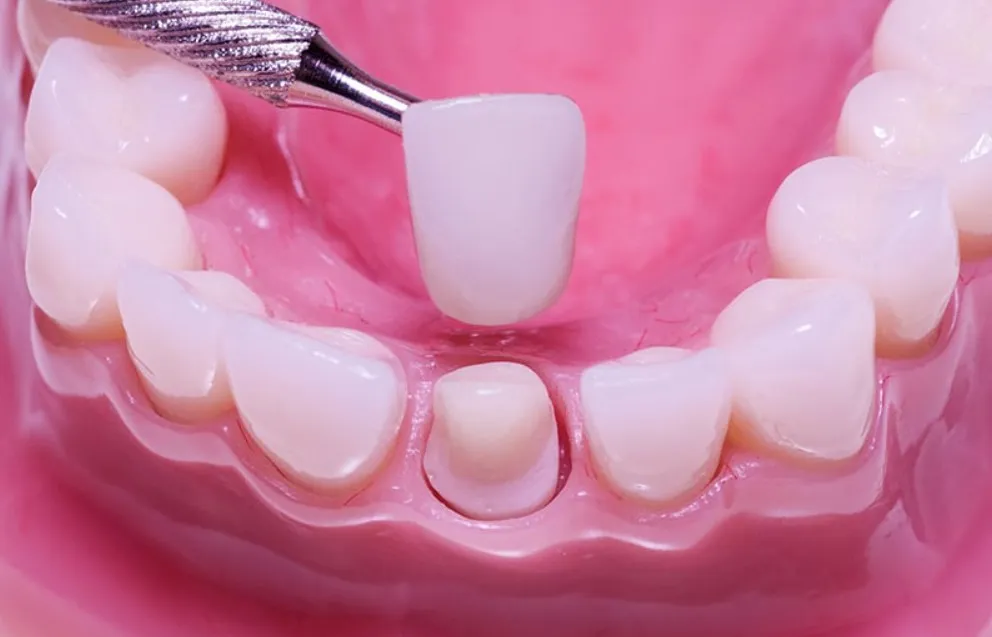 lắp răng tạm có ăn được không